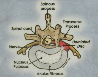 Pinched Nerve Image 1 Chiropractor