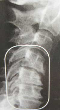 Pinched Nerve Image 1 Chiropractor