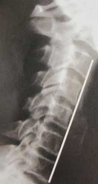 Pinched Nerve Image 1 Chiropractor