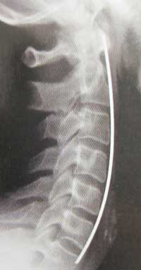 Pinched Nerve Image 1 Chiropractor