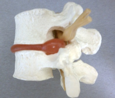 Pinched Nerve Image 2 Chiropractor